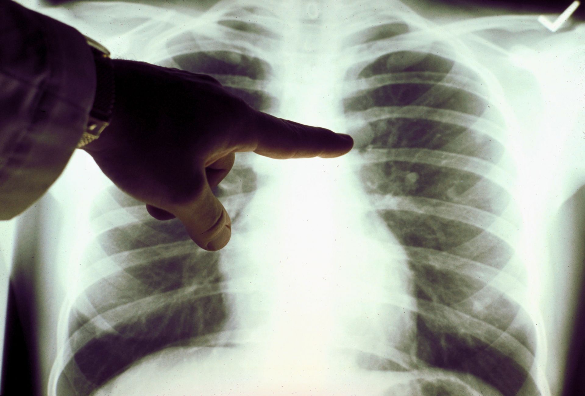 Καρκίνος του πνεύμονα: Tα σύγχρονα όπλα