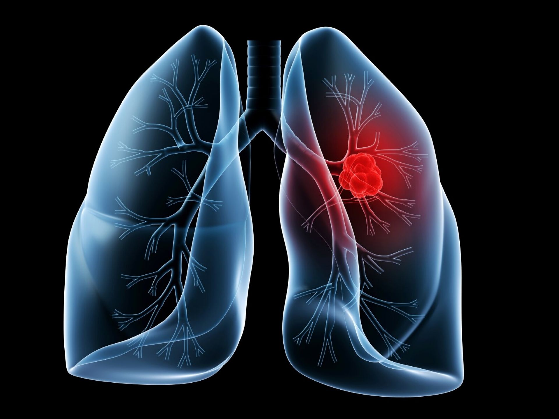 Φωτοδυναμική θεραπεία ενάντια στον καρκίνο του πνεύμονα