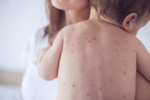 Ιλαρά: Κενά στον εμβολιασμό θέτουν προ των πυλών μια νέα υγειονομική απειλή